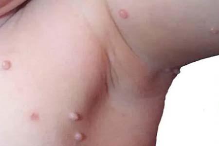 30 Hình ảnh sùi mào gà ở khắp cơ thể người bệnh