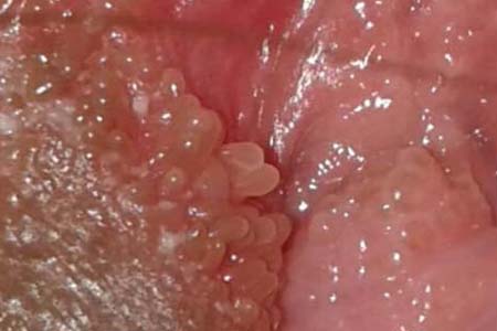 30 Hình ảnh sùi mào gà ở khắp cơ thể người bệnh