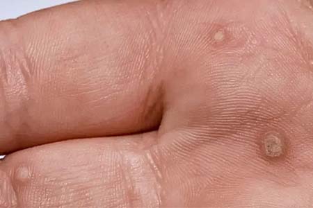 30 Hình ảnh sùi mào gà ở khắp cơ thể người bệnh
