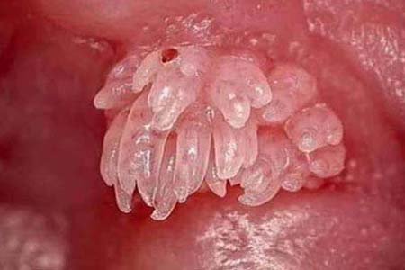 30 Hình ảnh sùi mào gà ở khắp cơ thể người bệnh