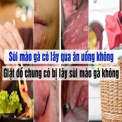 Sùi mào gà có lây qua ăn uống và giặt đồ chung không