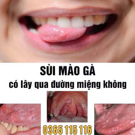 Sùi mào gà có lây qua đường miệng không, qua nước bọt không Sùi mào gà có lây qua đường miệng không, qua nước bọt không