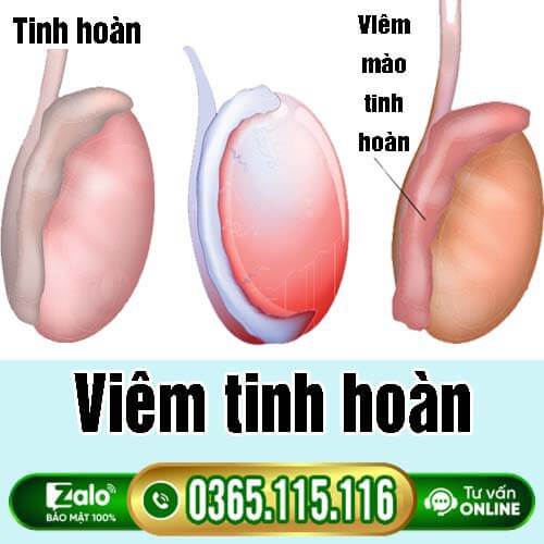 [Viêm tinh hoàn] Nguyên nhân, dấu hiệu và điều trị
